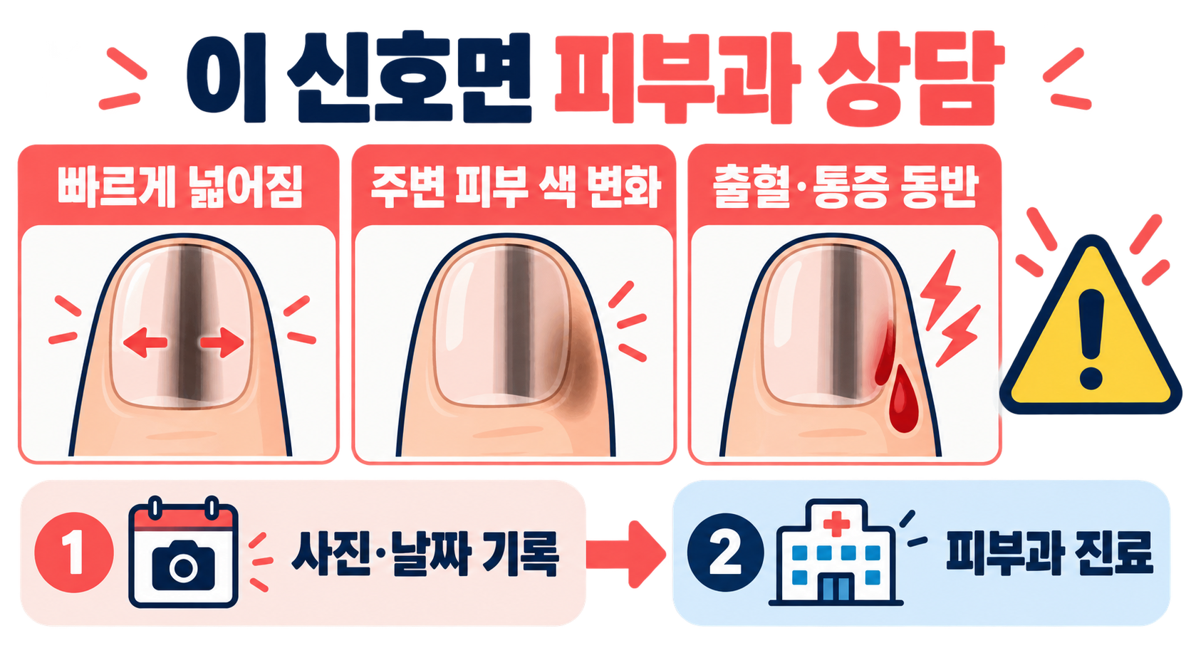 손톱 검은 세로줄: 흑색종을 걱정할 때 확인할 신호와 진료 기준 확인 정보 카드