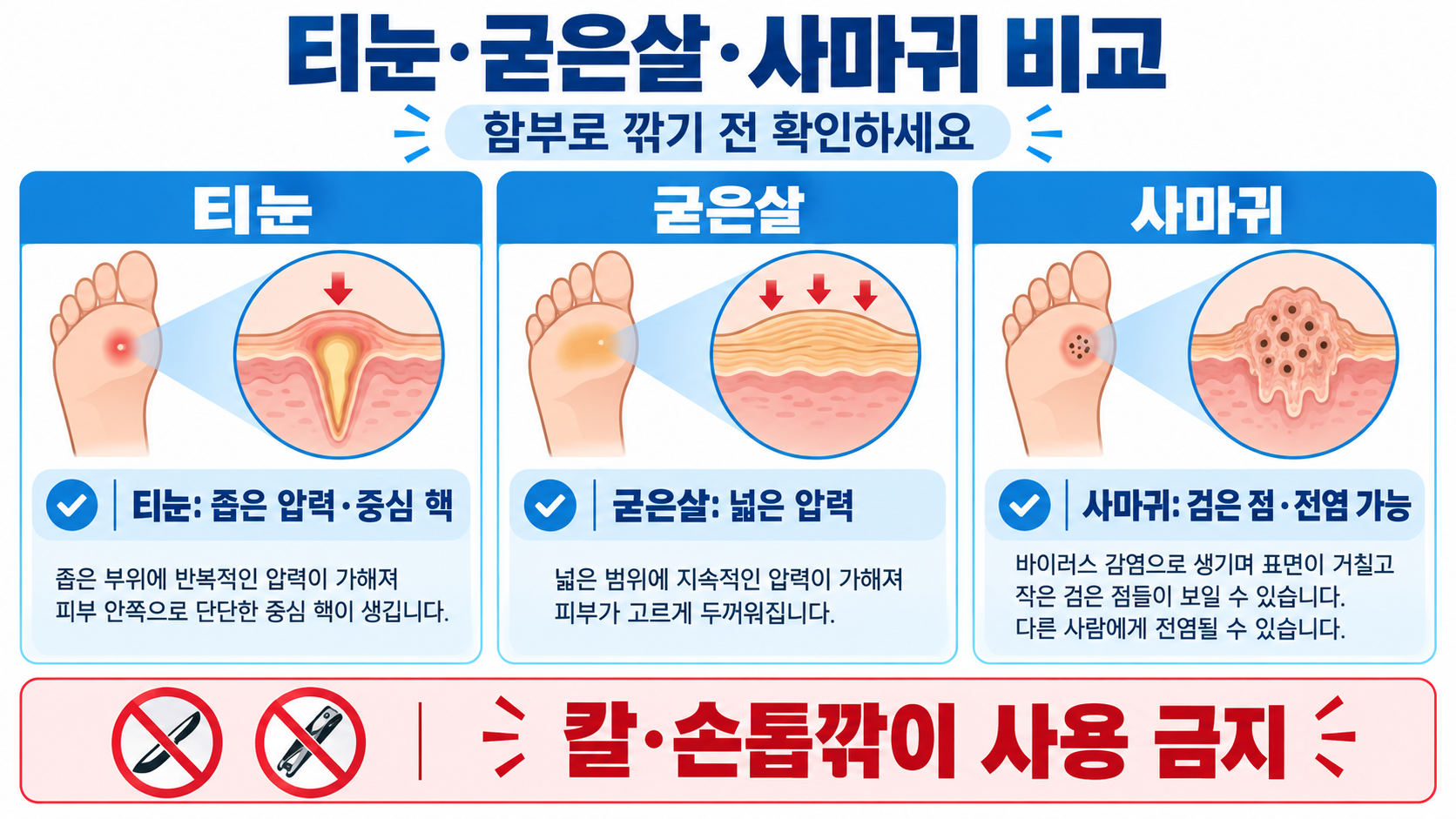 발바닥 티눈, 집에서 제거해도 될까? 원인·주의 신호·안전한 관리법 관련 정보 카드